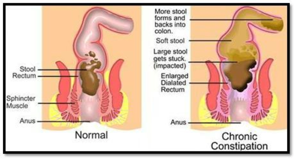 constipation awareness